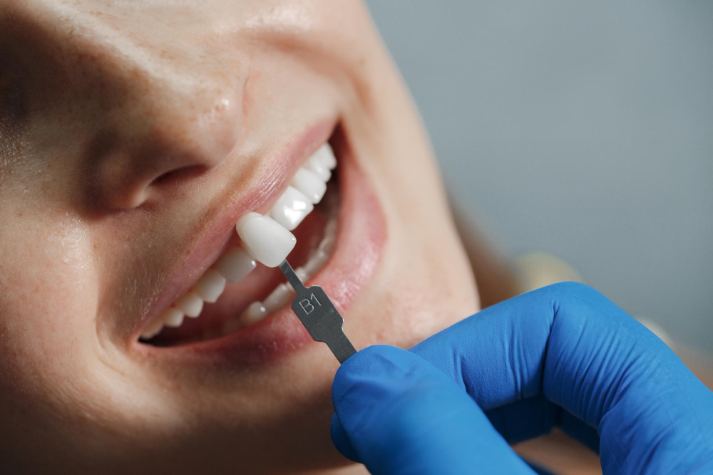 Dental Implants in Hyderabad